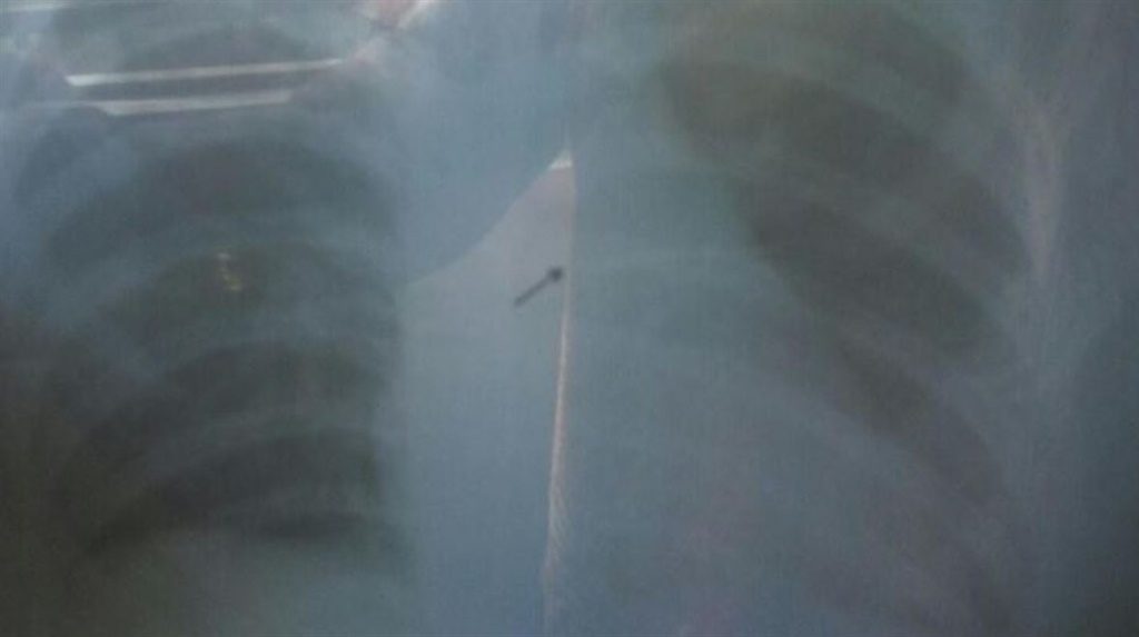 Girl (14) swallows needle