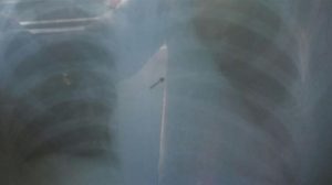 girl swallows needle